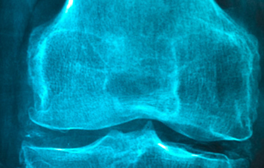 Röntgenbild eines verletzten Kniegelenks mit Osteoporose vom Arzt in Bonn
